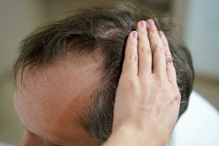 Erkeklerde saç dökülmesine ne iyi gelir?